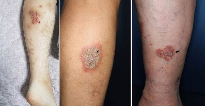 화폐상 습진은 습진이 동전모양의 동그란 형태로 나타난다. /고주연 교수 제공