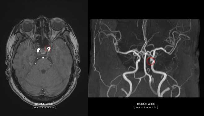 딥노이드의 뇌동맥류 뇌영상검출·진단보조소프트웨어 '딥뉴로' 구동 화면 (사진=딥노이드)