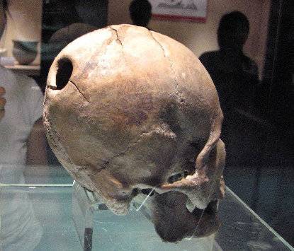 중국 산둥반도 유적에서 출토된 5000년 전 머리뼈에 직경 3cm가 넘는 구멍이 뚫려 있다(왼쪽 사진). 수술 흔적으로 추정되는데, 뼈가 한동안 자란 것으로 보아 환자가 상당 기간 생존했음을 짐작할 수 있다. 사진 출처 신화통신