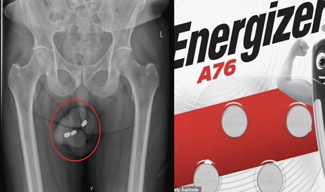 호주의 한 남성(73)이 요도에 1.3cm 크기의 건전지 3개를 넣은 사건이 공개됐다. [사진=데일리메일 캡처]