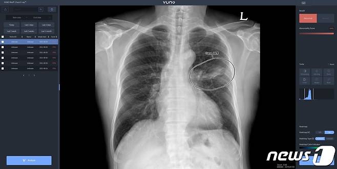 뷰노메드 체스트 엑스레이 활용 모습.(뷰노 제공)/뉴스1 ⓒ News1