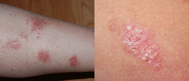 화폐상 습진(왼쪽)과 건선(오른쪽)은 발생 부위, 진행 속도 등으로 구별할 수 있다./사진=Water’s Edge Dermatology, 클립아트코리아