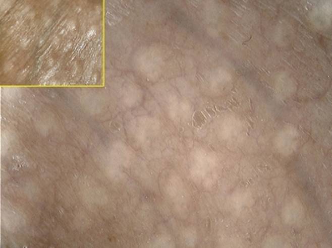 포다이스반은 성병과 전혀 무관하며, 전염성도 없기 때문에 특별히 치료할 필요가 없다. 사진은 음경 부위에 생긴 포다이스 반 군집을 현미경으로 확대한 모습.​/사진='Augmented diagnostic capability using videodermatoscopy on selected infectious and non-infectious penile growths'