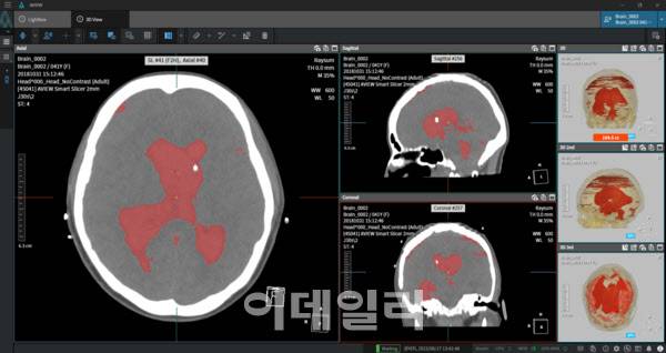 코어라인소프트의 뇌출혈 진단보조 솔루션 ‘에이뷰 뉴로캐드’(AVIEW NeuroCAD) (자료=코어라인소프트)