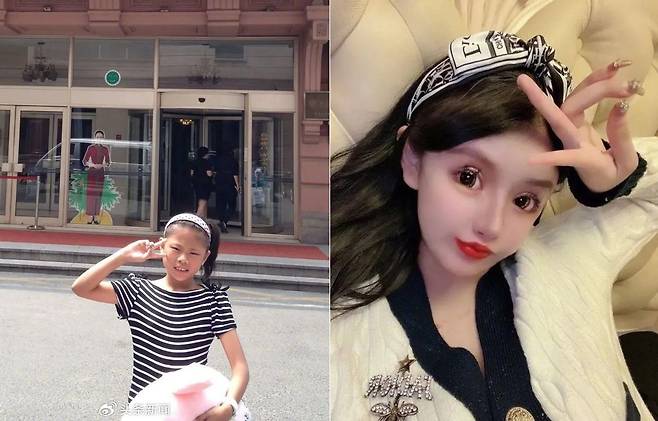 지난 5년간 100번 이상의 성형수술을 한 중국 저장성 출신의 저우추나(18). 왼쪽은 성형 전 모습. /웨이보