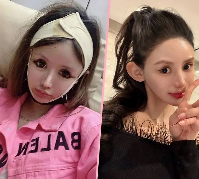 지난 5년간 100번 넘는 성형수술한 저우의 최근 모습. /SCMP