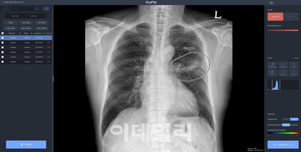 뷰노메드 체스트 엑스레이.(사진=뷰노)