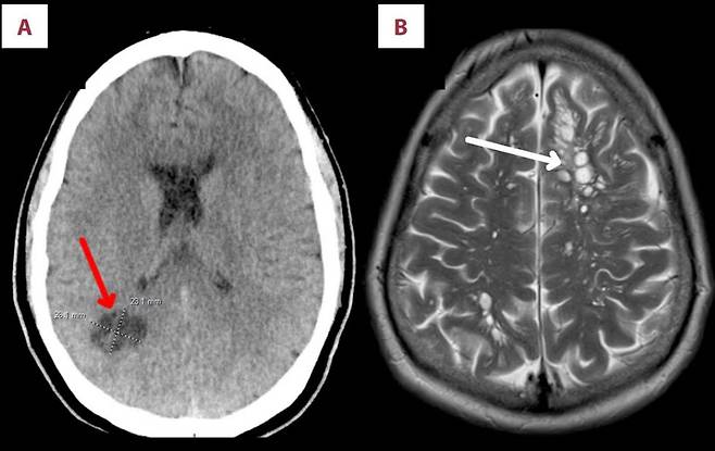 A씨의 뇌에 기생충 감염으로 인한 낭종(화살표 부분)이 생겼다./사진=American Journal of Case Reports​