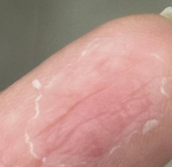 통증이나 가려움 등 아무런 증상 없이 원형 모양으로 피부 껍질만 벗겨진다면 일반적인 주부습진이 아닌, 박탈성각질융해증을 의심해야 한다./사진=헬스조선 독자 제보 사진