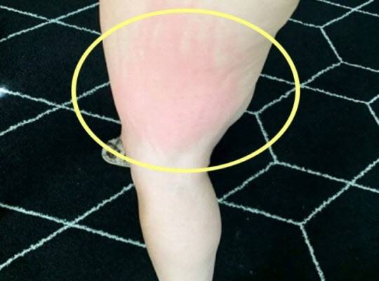 정액 알레르기로 인해 빨갛게 부은 앨리슨 테니슨(34)의 다리. (사진=더선 SNS 갈무리)