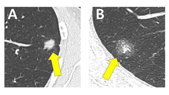(A)순수 고형(pure solid)으로 보이는 종양과 (B)간유리 음영(ground glass opacity) 종양의 컴퓨터단층촬영(CT) 이미지. 중앙대병원 제공