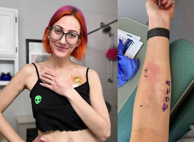 정액과 콘돔 알레르기에 더해 이런 혈액응고장애가 있음에도 불구하고 테니슨은 남편과 함께 아기를 임신할 수 있는 방법을 찾겠다는 희망을 버리지 않고 있다. [사진=미국 일간 뉴욕포스트 보도 캡처]