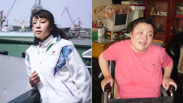 주링의 탈륨 중독 전(왼쪽)과 후(오른쪽) 사진. 주링은 21세였던 1994년 탈륨에 중독된 여파로 29년간 후유증에 시달린 끝에 2023년 12월 사망했다. 주링 재단 제공