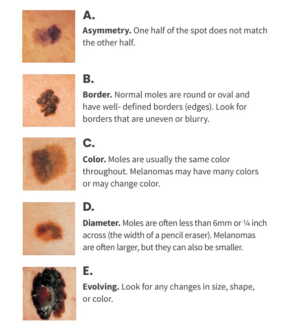 일반적인 점과 피부암의 차이는 ​'ABCDE 법칙'을 통해 구별해볼 수 있다./사진=미국암학회(American Cancer Society) 자료