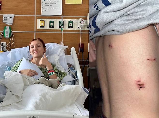 20세 여성 칼리 오즈커트는 15살부터 전자담배를 피우기 시작했고, 결국 오른쪽 폐에 두 번의 기흉이 생겼다. 수술 자국이 있는 오즈커트의 몸(오른쪽)./사진=뉴욕 포스트