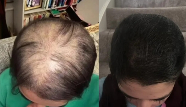 한 뷰티 애호가가 자신의 틱톡 계정에 탈모 후 다시 머리카락을 기르는 세가지 비결을 공개해 화제가 되고 있다.[영국 일간 더선·파빈 사호타 틱톡@parvsahota5]