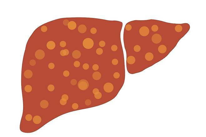 지방간/사진=클립아트코리아