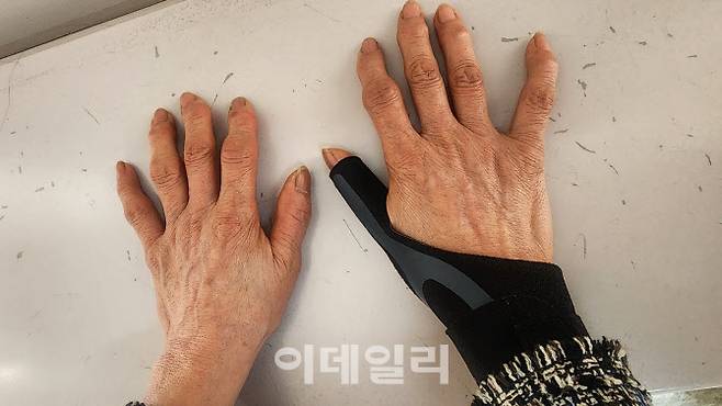 허리 수술 후 하반신이 마비된 강모씨의 아내의 손. 손가락 마디마디가 노동에 따른 후유증으로 뒤틀려 있다. (사진=백주아 기자)