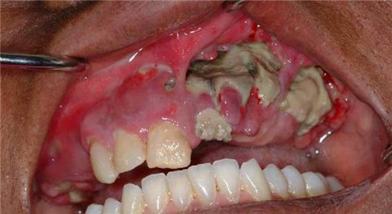 사진 출처: SL Ruggiero et al. J Oral Maxillofac Surg 2004.