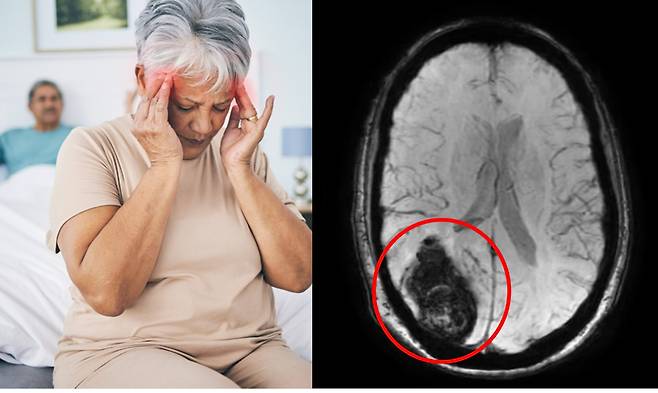 61세의 한 여성이 성관계 중 뇌출혈이 발생한 사례가 보고된 가운데, 전문가들은 예상보다 이런 일이 훨씬 흔하게 나타날 수 있다고 경고했다.  [왼쪽 사진=게티이미지뱅크 / 오른쪽 사진= 성관계 두통 후 뇌출혈 발생한 61세 여성의 뇌  스캔 이미지: 빨간 표시 부분이 뇌혈관 파열돼 나타난 핏덩어리, 상당히 많은 출혈이 발생한 것을 볼 수 있다. 출처=영국 일간 데일리메일 보도 캡처]