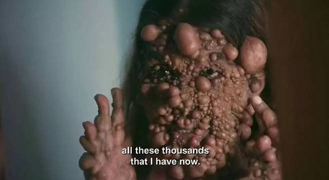 차메인 사헤디오(42)는 ‘신경섬유종증(neurofibromatosis)’ 때문에 피부에 수천 개의 종양이 있다./사진=더 미러