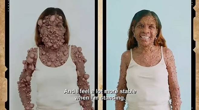 차메인 사헤디오가 신경섬유종증 수술을 받기 전과 후의 모습./사진=더 미러