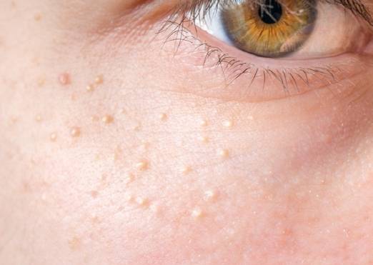 비립종은 피부의 죽은 각질 세포들이 합쳐져 생기는 각질 주머니다./사진=게티이미지뱅크