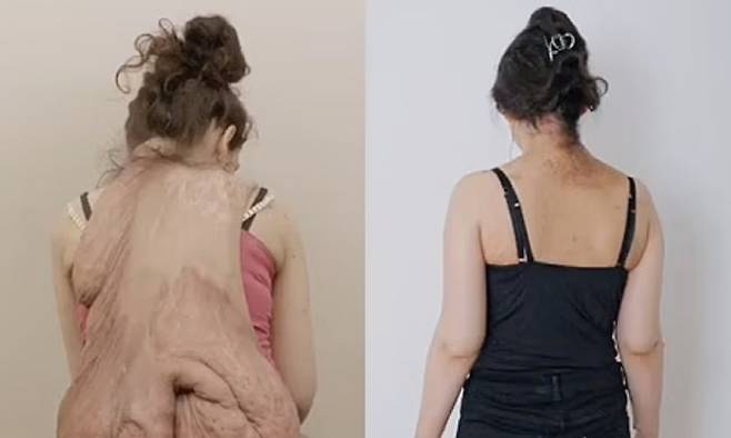 종양 제거 전(왼쪽)과 후의 알렉산드라 모습. 사진출처=데일리메일