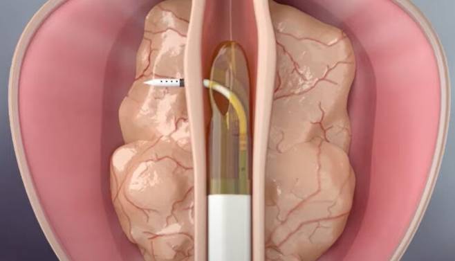 전립선비대증 리줌 시술. [사진=맨앤우먼비뇨기과]