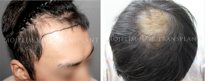M자 및 O자 탈모 유형별 모제림성형외과 내방 사례. 모제림성형외과 제공