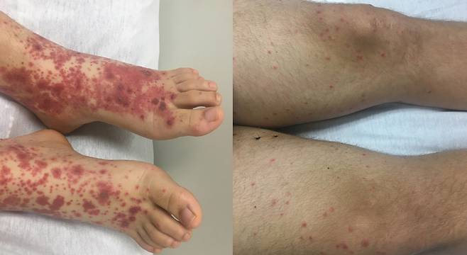 항생제의 일종인 설파메톡사졸-트리메토프림(SMT)​ 부작용으로 혈관염이 발생한 발과 다리./사진=임상사례보고