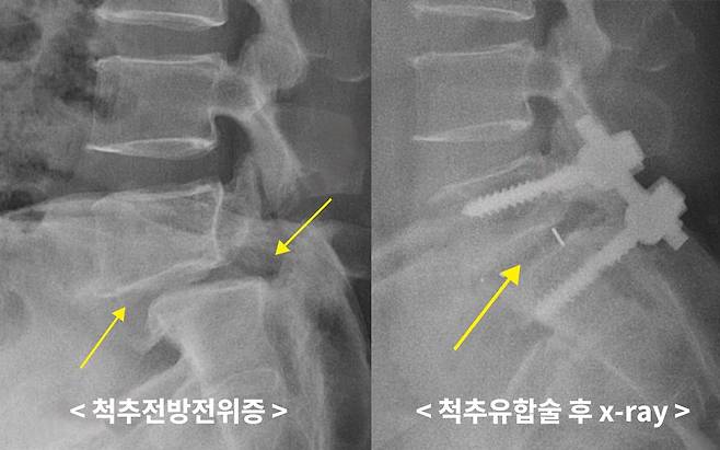 척추전방전위증 환자의 척추유합술 후 x-ray./사진=생생병원