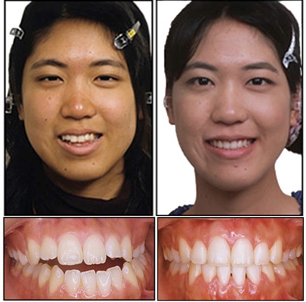 교정으로 치아의 비대칭과 부정교합이 크게 개선된 모습 . [사진=(Am J Orthod Dentofacial Orthop 2016;150:1028)]
