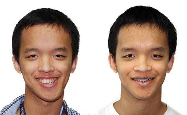 이렇게 양악수술로 비대칭이 좋아진 케이스는, 턱 끝 수술을 동시에 시행한 경우들입니다 .  [사진=drantipov.com ]