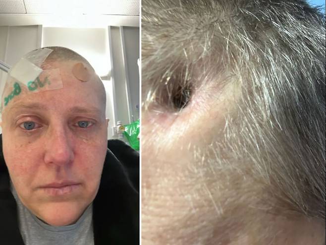 영국에서 사는 앨리나 실바나비슈트(44)는 골수염 때문에 지난 3월 두개골 일부를 제거했다./사진=더 선