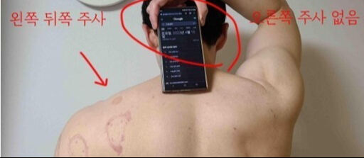 경기도 광주의 한 병원이 환자의 왼쪽 어깨에만 주사를 놓았는데, 마치 양쪽 어깨에 주사를 놓은 것처럼 진료 기록을 부풀려 건강보험료를 청구했다. 연합뉴스