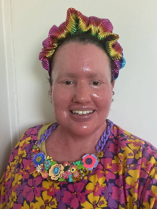 호주에서 사는 칼리 핀레이(42)는 태어날 때부터 할리퀸 어린선을 앓았지만, 꾸준한 관리를 통해 현재 작가로 활동하고 있다./사진=칼리 핀레이 SNS