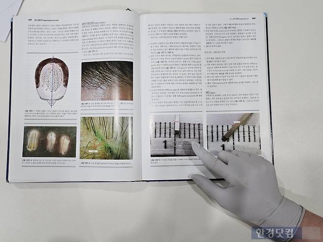 모발이식 수술 과정을 설명하는 A 씨. /사진=김영리 기자