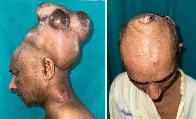 종양 제거 전(왼쪽)과 후의 모습. 사진출처=AIIMS-부바네스와르 병원, 더 선