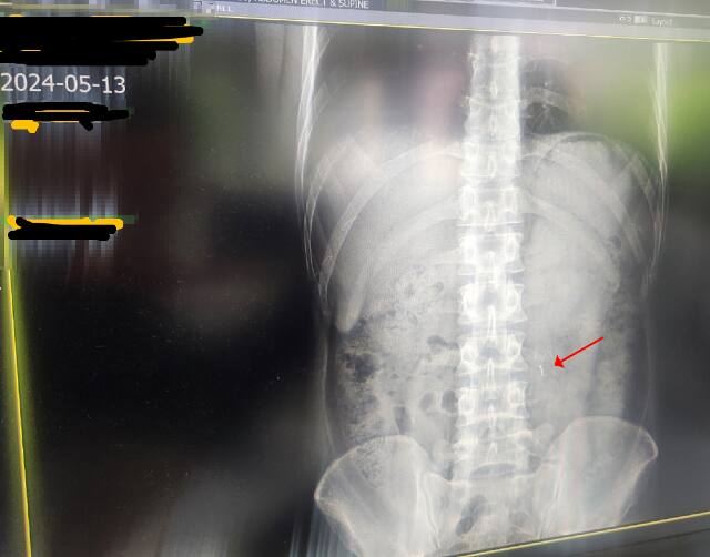 A씨 남편의 엑스레이에 담긴 주삿바늘로 추정되는 이물의 모습. 보배드림 캡처