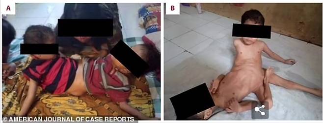 의료진은 아이들이 똑바로 앉을 수 있도록 하기 위해 기능하지 않는 다리 하나를 절단하고 골반 부위 뼈를 안정시키는 힘든 수술을 진행했다. [사진=데일리메일 보도 갈무리/ 출처=American Journal of Case Reports ]