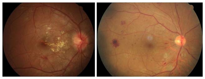 (좌) 고혈압망막병증 환자의 안저사진, (우) 당뇨망막병증 환자의 안저사진 (출처 김안과병원).