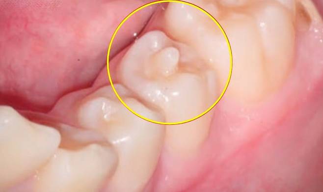 치외치가 있는 이빨. /사진=유튜브 '치대남' 캡처