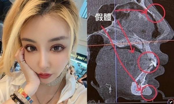기사 사진에 얼굴에 여러 개의 '못'이 있다며 모델이 올린 사진에서 실제 나사는 단 하나이며, 나머지는 코 뼈와, 치아가 CT 상 날카롭게 나온 것에 불과했습니다. [사진=팡 기원 SNS]