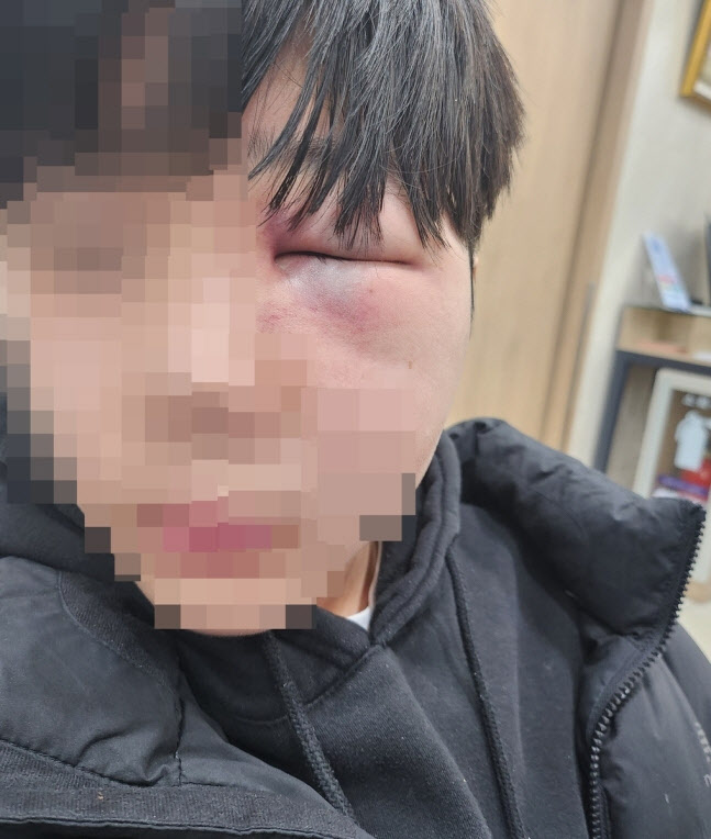 폭행으로 망막이 훼손된 피해 학생 얼굴 (사진=연합뉴스)