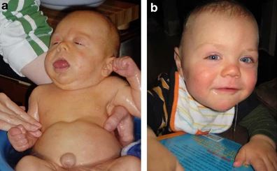 베크위트-비데만 때문에 큰혀증과 배꼽탈장을 겪은 아기의 모습./사진=European Journal of Human Genetics
