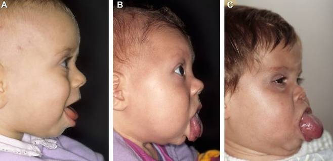 베크위트-비데만 환자들은 배꼽탈장을 치료하는 수술이나 혀의 크기를 줄이는 수술 등을 받는다. 혀 크기를 축소하는 수술을 받은 아기./사진=International Journal of Oral and Maxillofacial Surgery