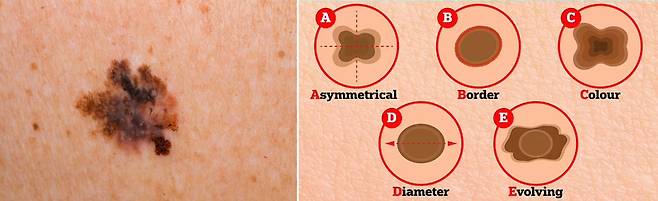 점의 모양이 균일하지 않고 여러 가지 색이 섞여있다면 피부암을 의심해봐야 한다./사진=클립아트코리아, Dailymail