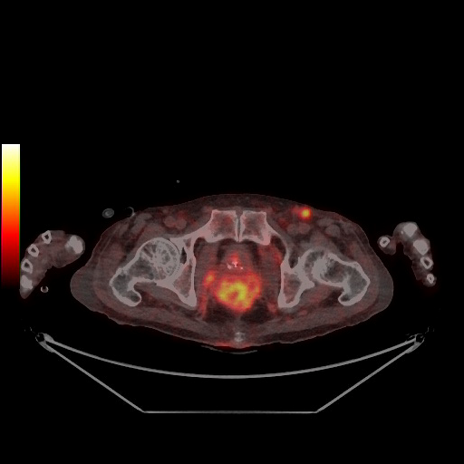 직장암 환자의 PET-CT 검사 결과 골반 안쪽의 직장암과 서혜부의 전이된 림프절이 활성화되어 붉은 색을 띠고 있다. 사진 제공=고대구로병원
