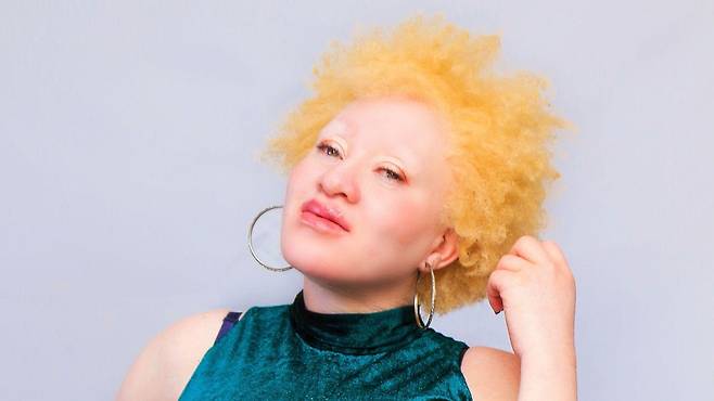 백색증을 앓는 레지나 메리 응들로드부는 백색증에 대한 인식을 높이고자 노력 중이다